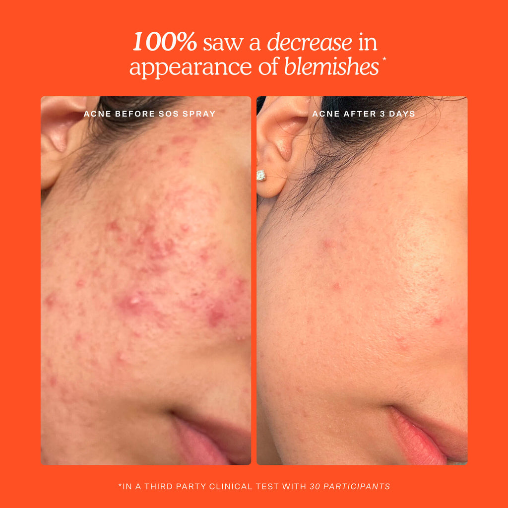 SOS Skincare Minis Kit